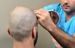 Is Hair Transplant Worth It Benefits Risks and Real Results
