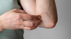 Treating Skin Infections with Antibiotics at Home