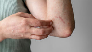 Treating Skin Infections with Antibiotics at Home