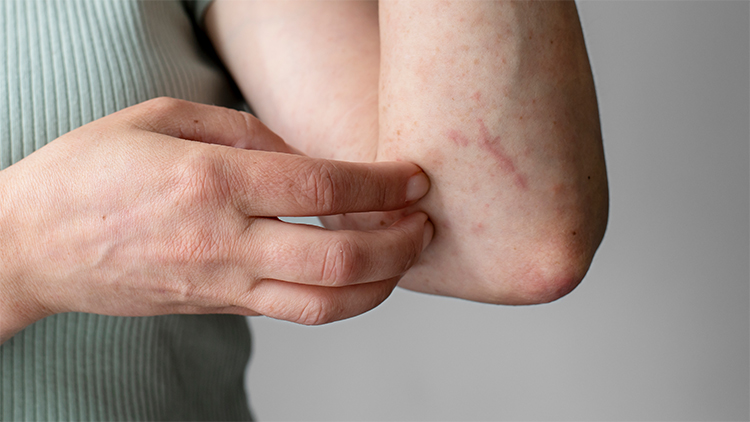 Treating Skin Infections with Antibiotics at Home