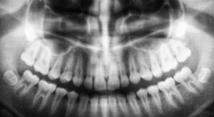 Panoramic Dental X-Ray