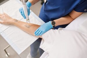 Picosure Tattoo Removal Secrets for Smooth and Spotless Skin