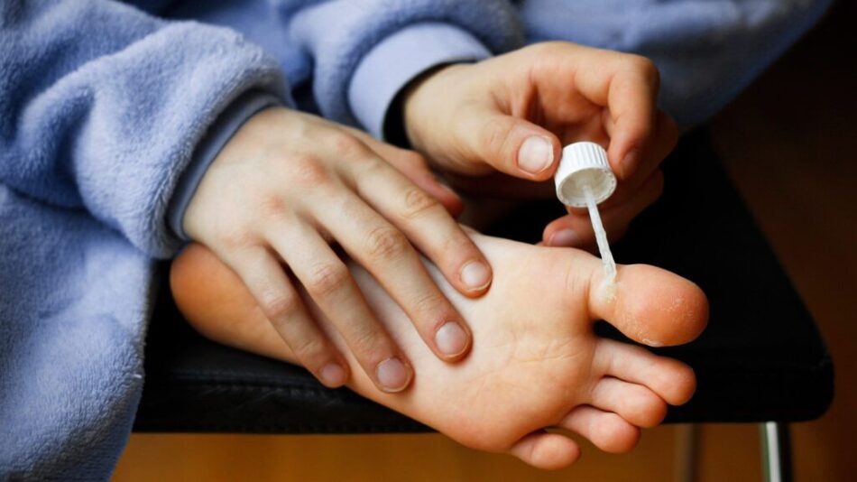 Skin Wart Removal With Salicylic Acid