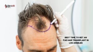 Best Time to Get an FUE Hair Transplant in Los Angeles
