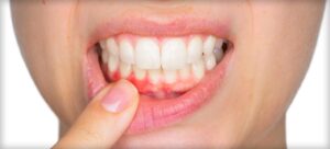 Understanding Gum Disease: Early Signs & Prevention