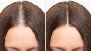What Is PRP Hair Treatment and Why Is Everyone Talking About It?