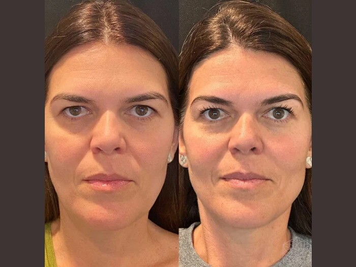 The Best Plastic Surgeons in Dubai Now Offer Advanced Thread Lift Techniques