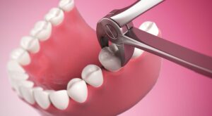 Tooth Extraction