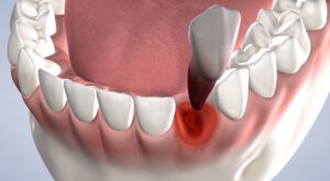 Tooth Extraction