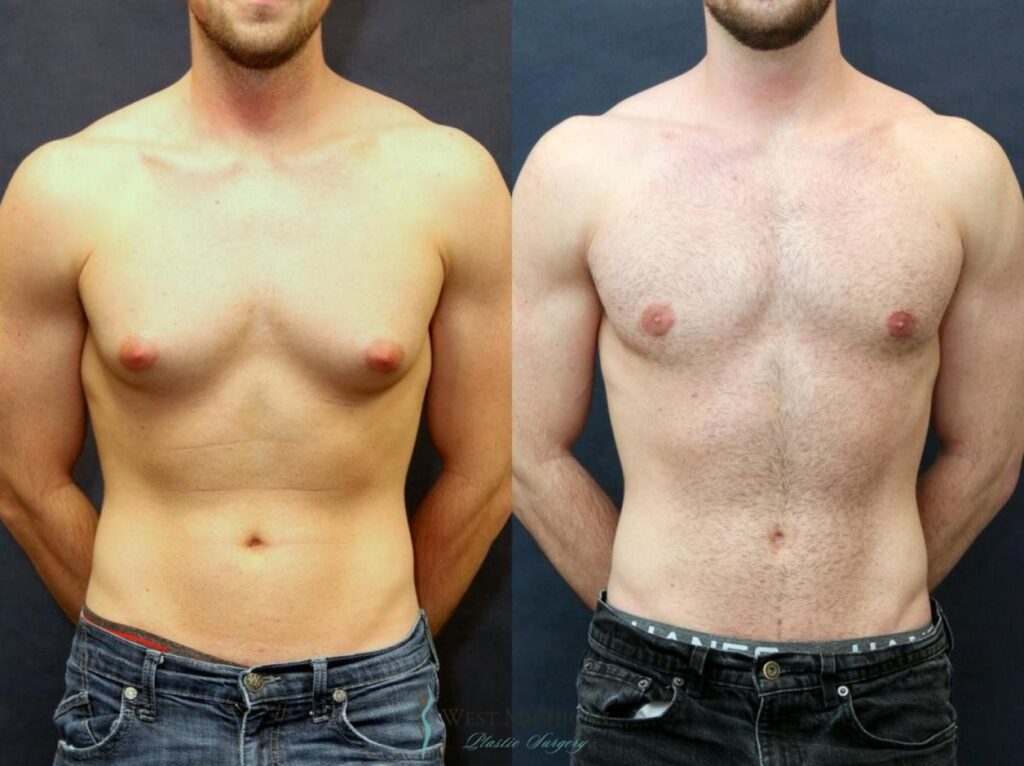 Gynecomastia Treatment