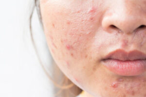 How Acne Treatment Helps You Achieve Blemish-Free Beauty
