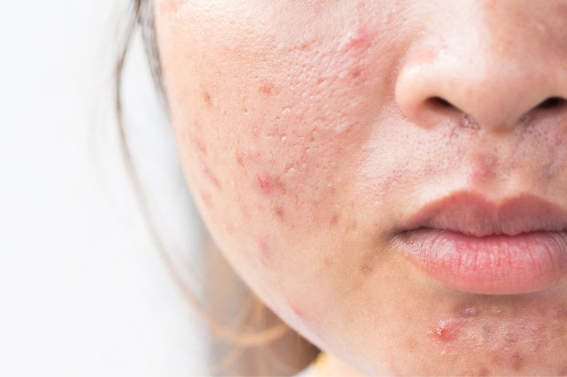 How Acne Treatment Helps You Achieve Blemish-Free Beauty