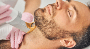 What Is Beard Laser Hair Removal and How Does It Work?