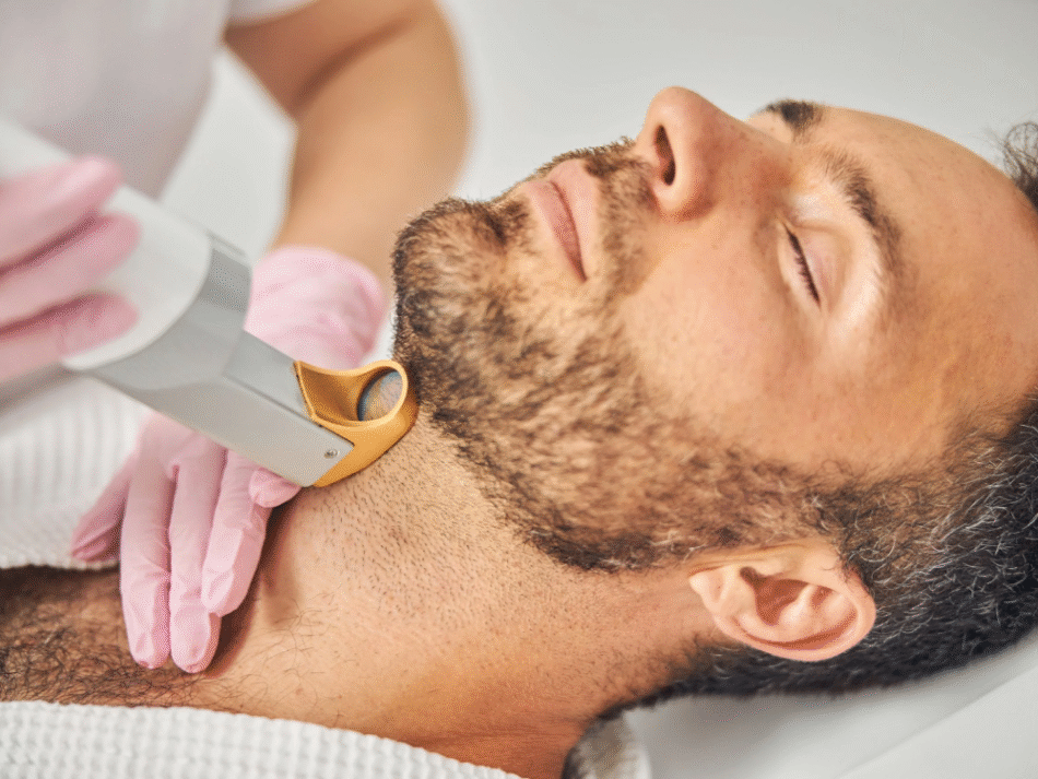 What Is Beard Laser Hair Removal and How Does It Work?