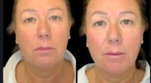 Rejuvenate Your Look with Non-surgical Facelift Treatment in Dubai