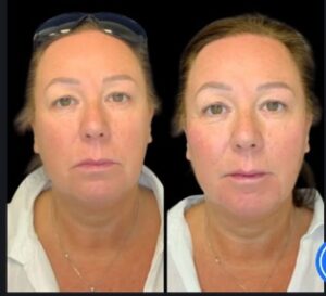Rejuvenate Your Skin with a Non-Surgical Facelift in Dubai