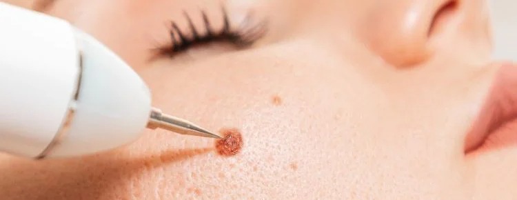Skin Wart Removal