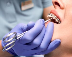 Orthodontic Dentistry in Dubai: The Rise of Invisible Aligners and Digital Braces