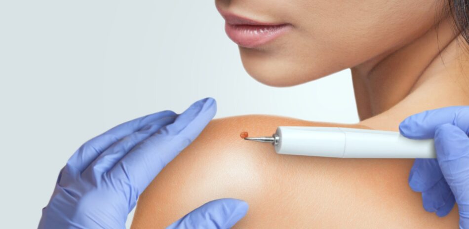 Skin Wart Removal