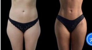 Transform Your Look Instantly with Non-Surgical J-Plasma Treatments in Dubai