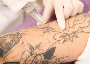 Transform Your Skin with Advanced Picosure Tattoo Removal