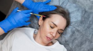 Best PRP Hair Treatment Benefits for Men and Women