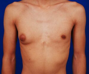 Understanding Gynecomastia from Steroids