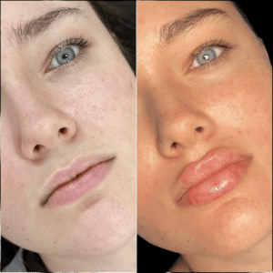Safe and Effective Fillers Treatments in Dubai for All Skin Types