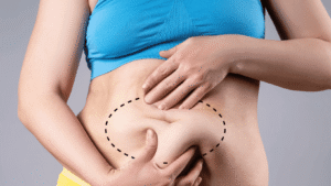 Why a Tummy Tuck Is the Key to Long-Lasting Core Confidence