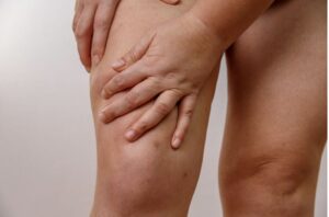 Riyadh Lipedema Health Clinics