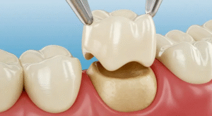 How to Care for Dental Crowns and Bridges