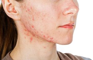 How to Choose an Acne Treatment That Gives Fast and Clear Results