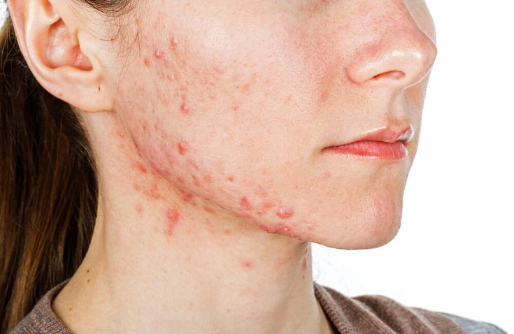 How to Choose an Acne Treatment That Gives Fast and Clear Results