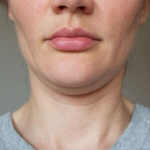 Double Chin Removal Secrets to Regain Your Youthful Appearance
