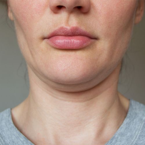 Double Chin Removal Secrets to Regain Your Youthful Appearance