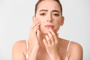 How to Choose the Right Acne Treatment for Lasting Results