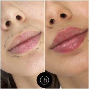 Combining Juvederm with Botox by the Best Doctors in Dubai