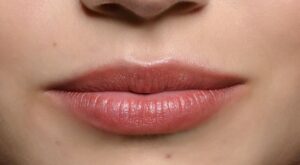 Pink Lips Laser Treatment for Safe, Even Tone and Quick Glow