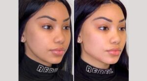 Innovative Thread Lift Methods Recommended by Best Plastic Surgeon in Dubai