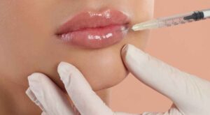 Are the Best Lip Fillers Injections Right for You? Expert Guide
