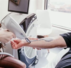 Picosure Tattoo Removal Explained: Is It Really the Safest Option?