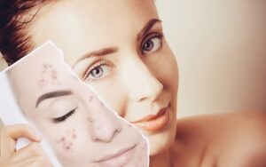 Acne Scar Treatment in Dubai: How to Choose the Right Clinic