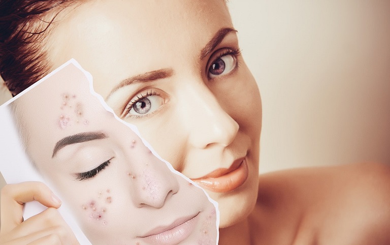 Acne Scar Treatment in Dubai: How to Choose the Right Clinic