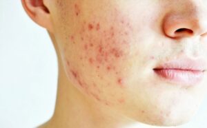Advanced Acne Scar Treatments in Dubai for Every Skin Tone