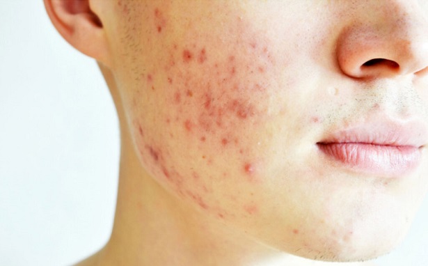 Advanced Acne Scar Treatments in Dubai for Every Skin Tone