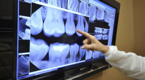Panoramic Dental X-Ray cost for Children and Adults