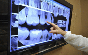 Panoramic Dental X-Ray cost for Children and Adults