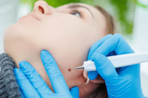 Birthmark Removal in Dubai: Top Clinics Recommended by Experts