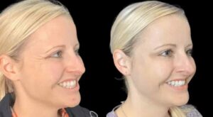 Achieve a Fresh Look with the Best Doctors in Dubai for Botox