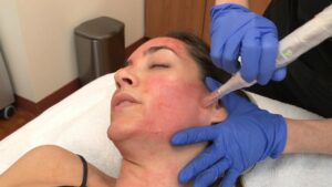 Can Microneedling Reduce the Appearance of Large Skin Pores?